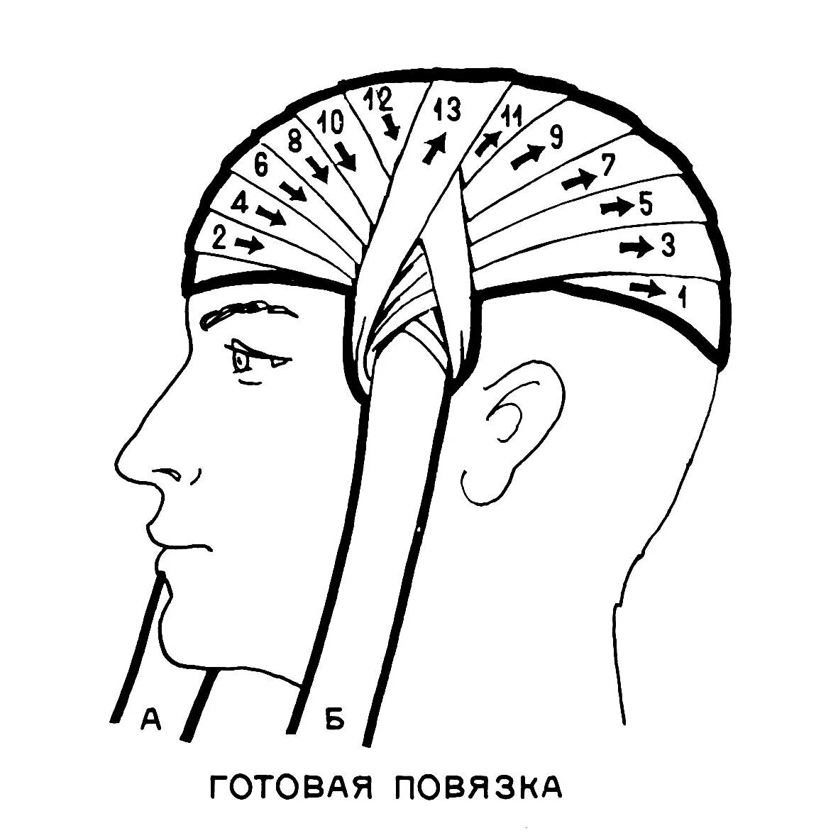 Повязка чепец. Техника наложения наложения повязки чепец.. Перевязка головы чепец. Десмургия повязка чепец.