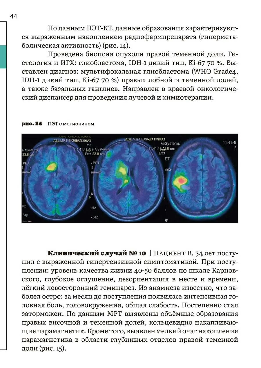 Многоочаговое поражение вещества головного мозга. Мультифокальное поражение вещества головного мозга. Гиподенсивные очаги головного мозга что это такое. ПЭТ кт с метионином доброкачественная опухоль. Многоочаговое поражение головного мозга