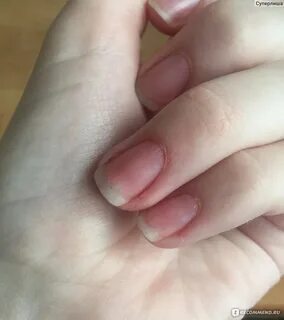 Аллергия на гель для ногтей