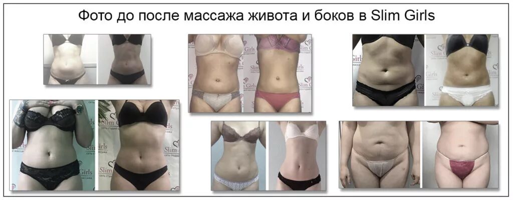 Как убрать живот после кесарева сечения. Массаж живота для похудения до и после. вакуумный массаж живота до и после. вакуумный массаж живота lj gjckt. массаж банками вакуумными для живота до и после.