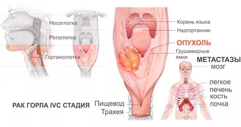 Как ощущается рак. Опухоли гортани и ротоглотки симптомы. 1 Признаки онкологии горла. Злокачественные опухоли гортани 1 степень. РФК горла.