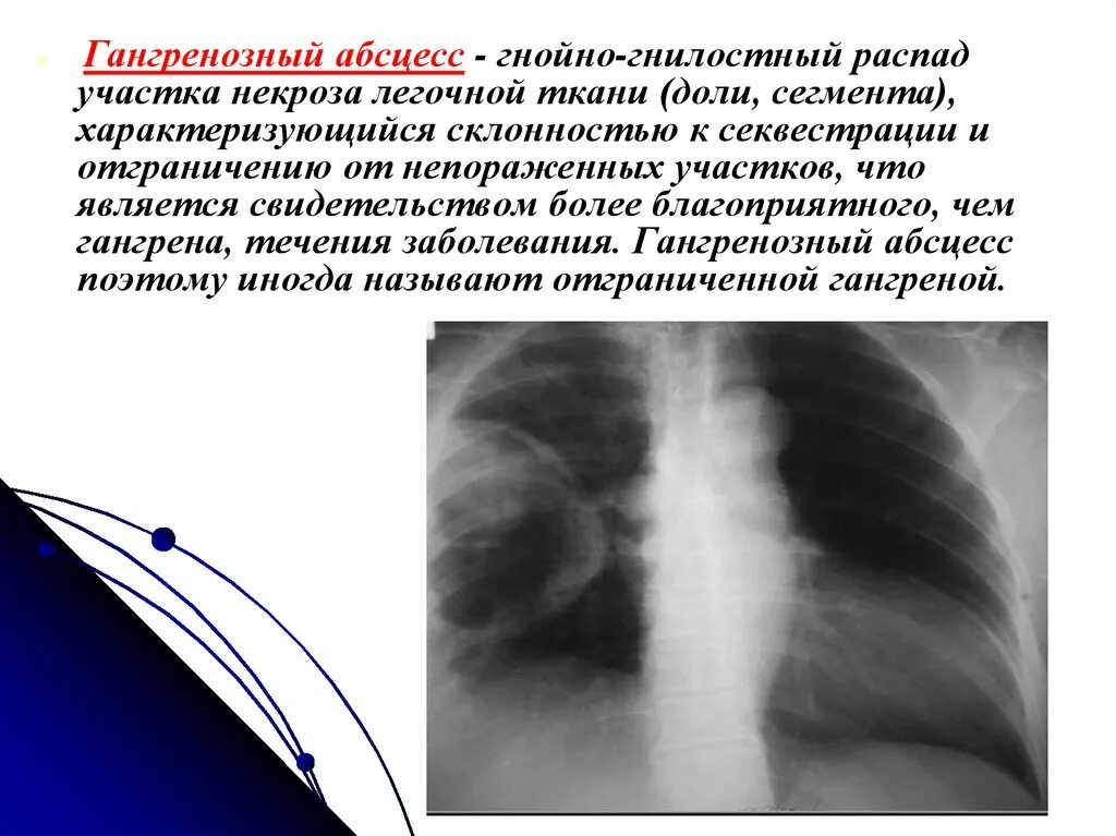 Абсцесс и гангрена легкого. Гангренозный абсцесс рентгенограмма. Гангренозный абсцесс рентген. Гангренозный абсцесс легкого кт. Абсцесс и гангрена легкого рентген.