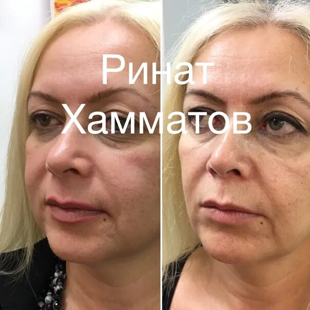 Липолитик в лицо до и после Липолитики В Веки Фото До И После Telegraph