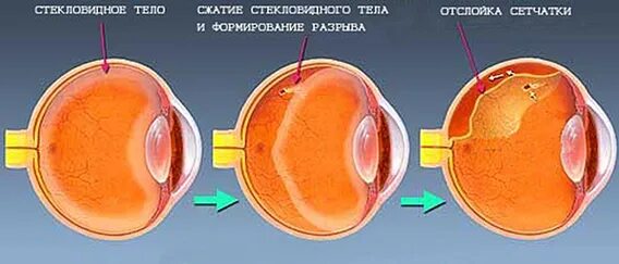 Воронкообразная отслойка сетчатки. Отслойка мембраны стекловидного тела. Периферическая отслойка сетчатки. Отслоение стекловидного тела в глазу.