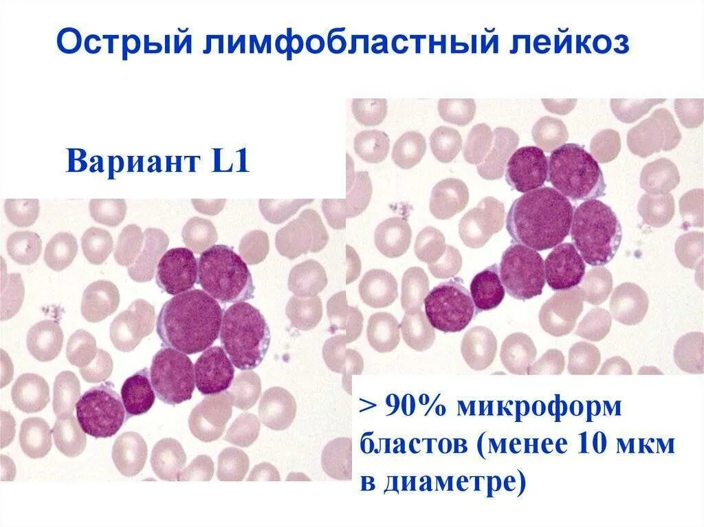 Острый лимфобластный и миелобластный лейкоз. Острый лимфобластный лейкоз l1. Острый лимфоидный лейкоз. Острый лимфобластный лейкоз (l2) картина крови. Лимфобластный лейкоз у взрослых