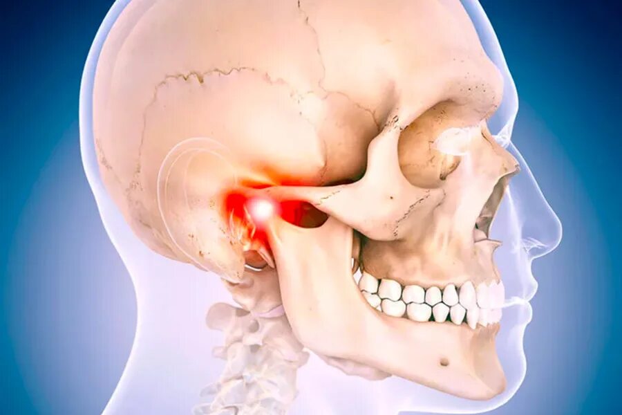При открытии рта болит ухо. Анкилоз височно-челюстного сустава. Височно-нижнечелюстной артроз. Артрит височно-нижнечелюстного сустава симптомы.