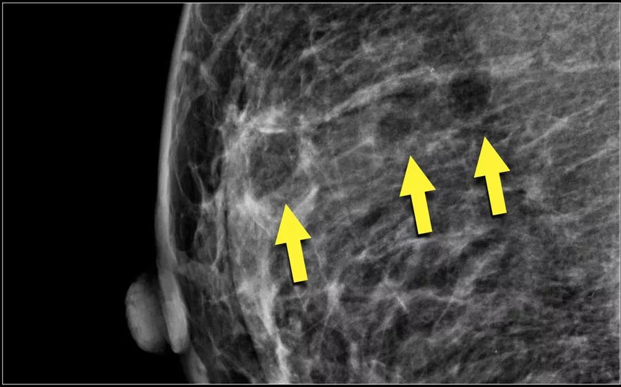Киста o rads. Киста молочной железы маммограмма. Гамартома молочной железы маммография. Маммография рентген снимки. Киста молочной железы рентген.