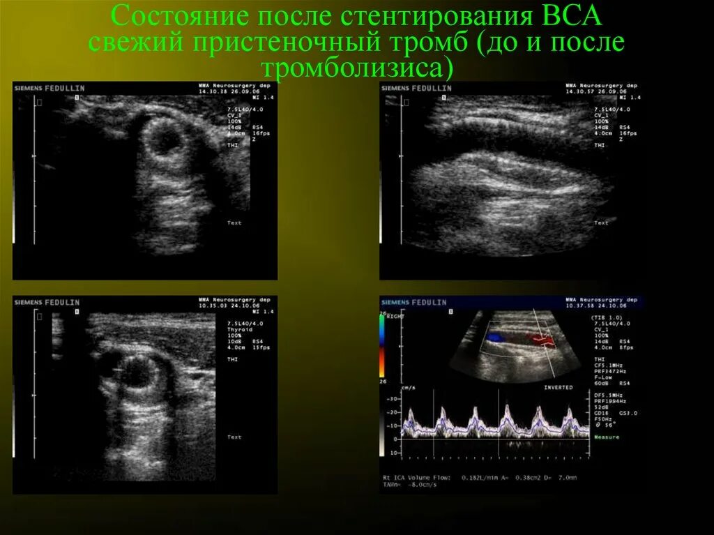 ВСА на УЗИ. УЗИ после стентирования. Состояние после стентирования. Пристеночный тромб УЗИ. Пристеночный тромбоз