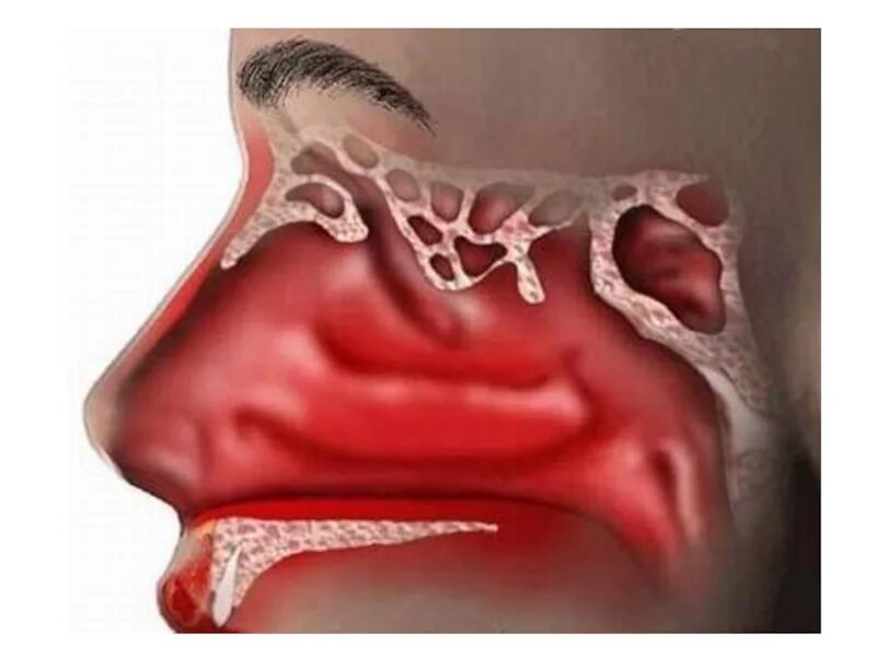 Хронический катаральный ринит. Острый аллергический ринит. Катаральный ринит слизистая. Сильно текут сопли