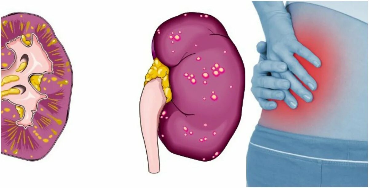 Почечная болезнь пиелонефрит. Острый левосторонний пиелонефрит. Острый пиелонефрит почка. Воспаление почек пиелонефрит. Острый очаговый пиелонефрит.