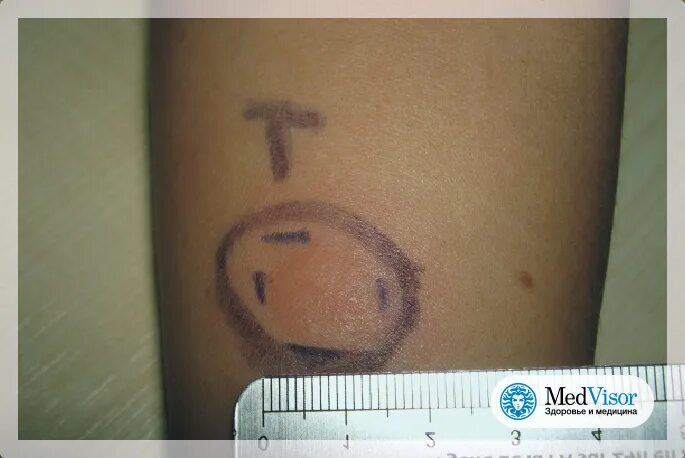 Реакция манту у ребенка 7 лет. Туберкулинодиагностика (проба манту с 2 те). Диаскинтест папула 10 мм. Туберкулин реакция манту положительная.