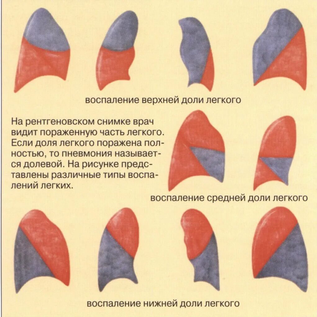 Двухсторонняя пневмония. Долевая пневмония. Как отличить боль в легких