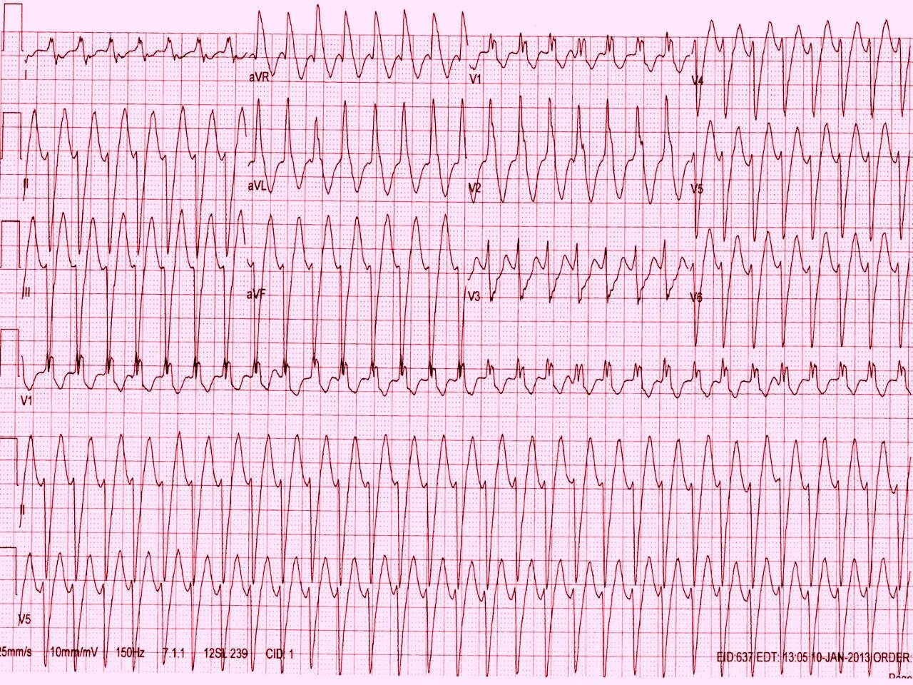 Желудочковая тахикардия на экг. Пароксизмальная желудочковая тахикардия на ЭКГ. ЭКГ при желудочковой пароксизмальной тахикардии. Желудочковая тахиаритмия ЭКГ.