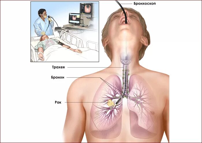Бронхоскопия мокроты. Бронхоскопия эндоскопическое исследование бронхов. Бронхоскопия методика проведения. Бронхоскопия инородное тело. Эндоскопические методы исследования органов дыхания.