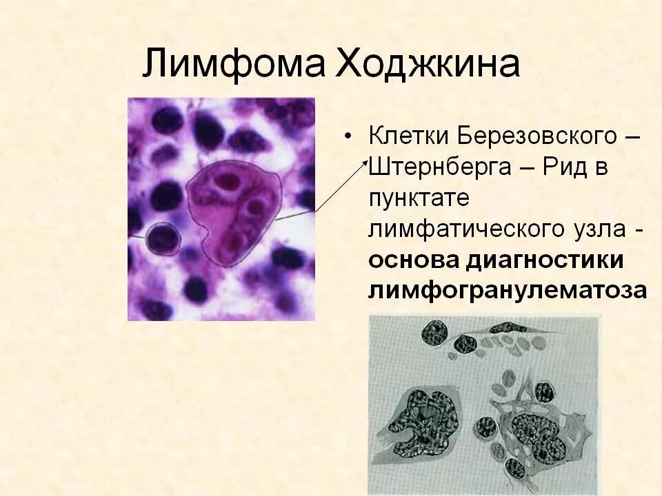 Лимфома лимфатические узлы. Клетки Рид-Березовского-Штернберга. Клетки Рида Березовского Штернберга. Клетки Березовского Штерн. Клетки Рид–Березовского–Штернберга при лимфоме Ходжкина.