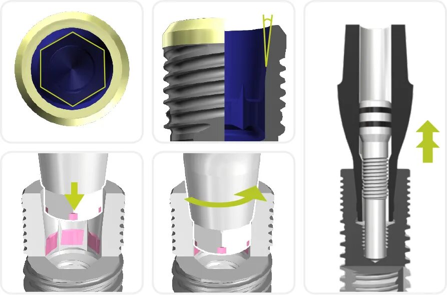 Internal thread. Биогоризонт абатмент. Биогоризонт импланты. Интерфейс имплантат-абатмент. Имплант зуба Биогоризонт.