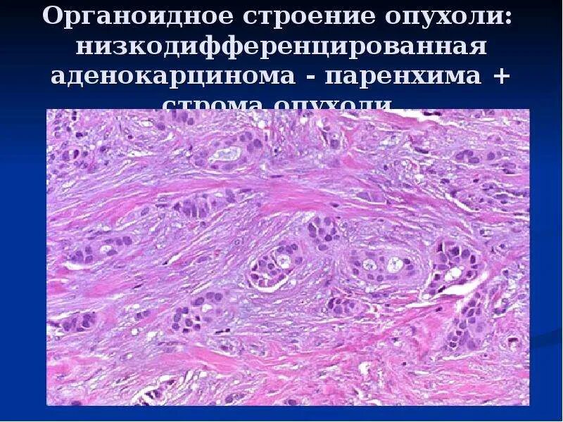 Рак матки гистология. Муцинозная аденокарцинома гистология. Высокодифференцированная аденокарцинома гистология. Аденокарцинома легкого ГИСТ. Серозная карцинома гистология.