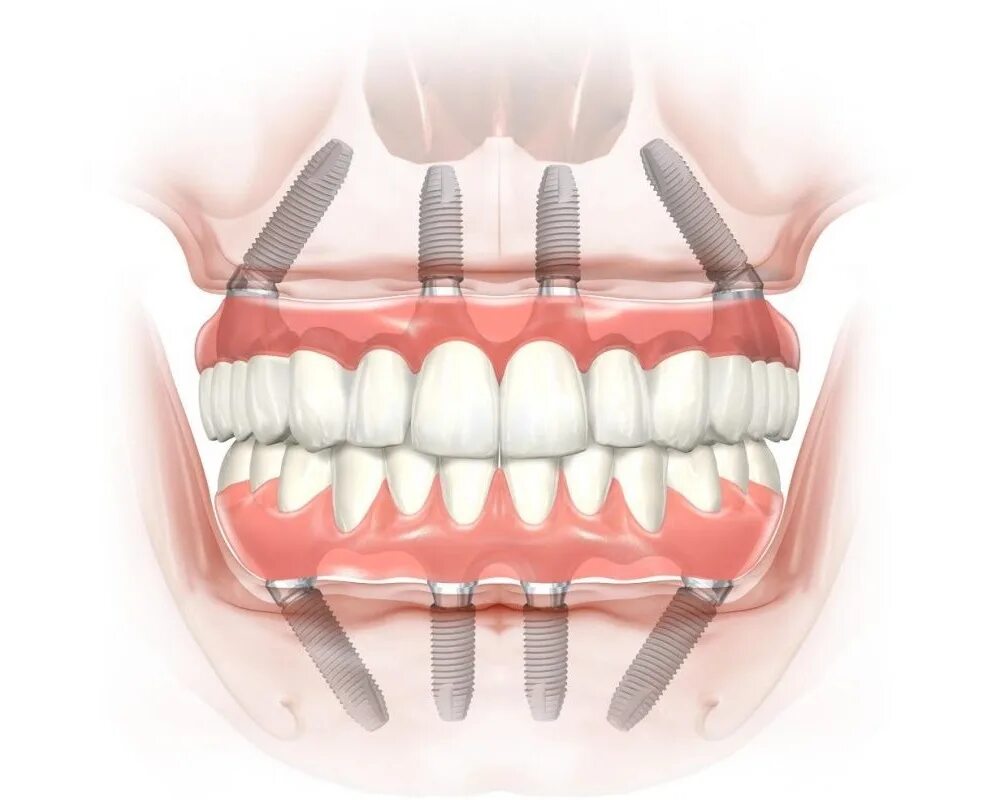 Технология протезирования зубов all-on-4. Имплантация челюсти на 4.