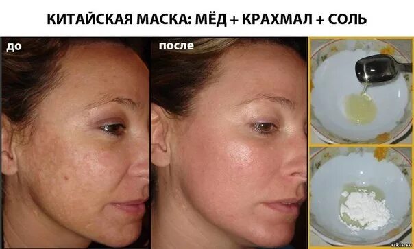 Маска из крахмала для лица до и после. Пигментация на лице до и после. Отбеливание кожи от пигментации. Пигментация после пилинга.