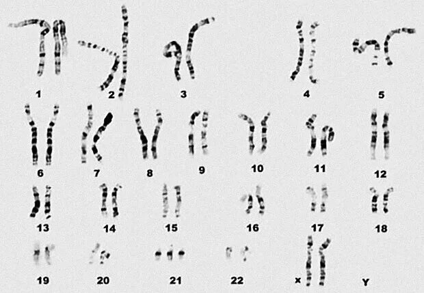 Синдром Дауна 21 хромосома. Хромосомы при синдроме Дауна. Трисомия 22 хромосомы кариотип. Кариотип человека с аутизмом. Лишняя 21 хромосома