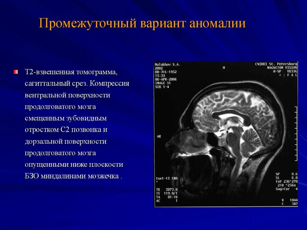 Аномалия киари степени. Аномалия Арнольда Киари на кт. Мальформация Арнольда-Киари 1. Аномалия Арнольда Киари мрт. Мальформация Арнольда-Киари мрт.