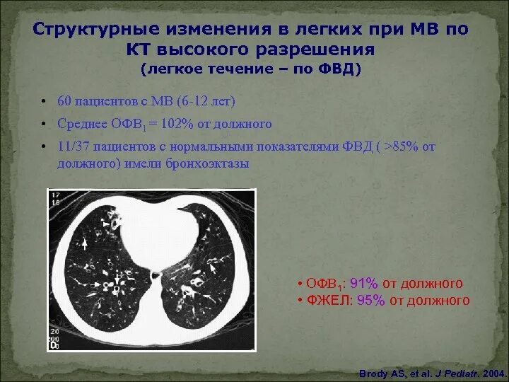 Структурные изменения в легких что это такое. Муковисцидоз на кт легких. Изменения в легких при муковисцидозе кт. Что означает изменения в легких