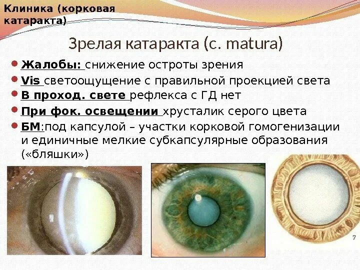 Начальная старческая катаракта. Заднекапсулярная катаракта. Зрелая стадия катаракты. Жалобы при зрелой катаракте. Презентация на тему катаракта.