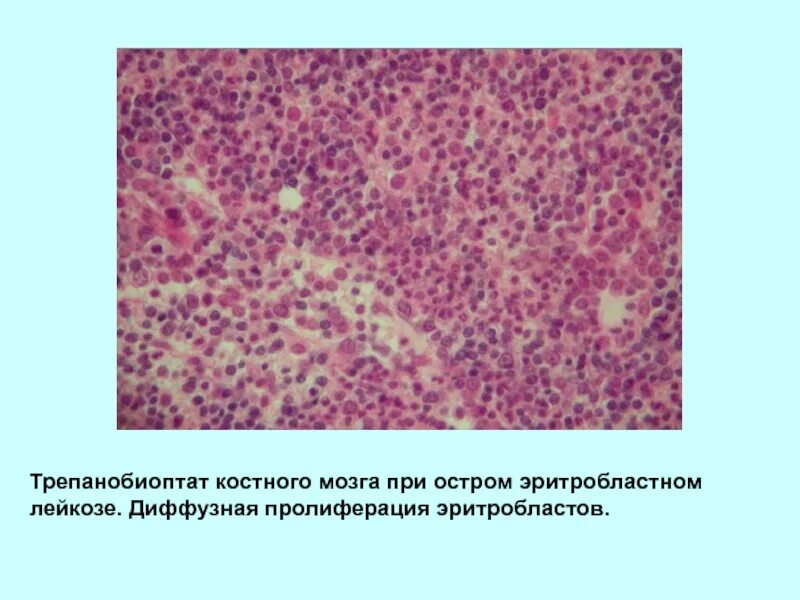 Миелобластный лейкоз сыпь. Лейкоз патологическая анатомия. Лейкозы патологическая анатомия препарат. Пунктат костного мозга при острых лейкозах.