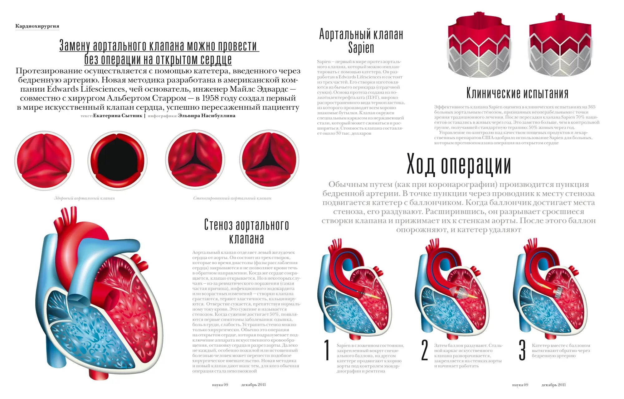 Операция по установке аортального клапана. Операция на клапан сердца. Операции на аортальном клапане. Как клапан делает операция