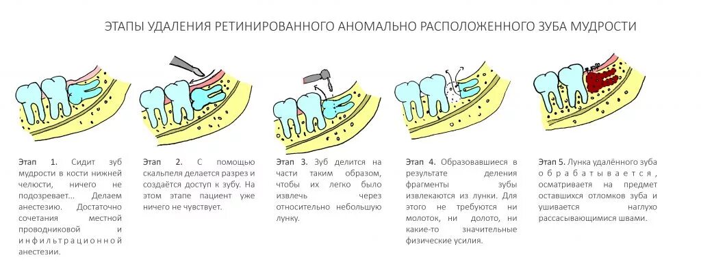 После удаления зуба можно ли пить воду. Этапы операции удаления зубов. Этапы удаления ретинированного зуба. Заживление удаленного зуба мудрости.