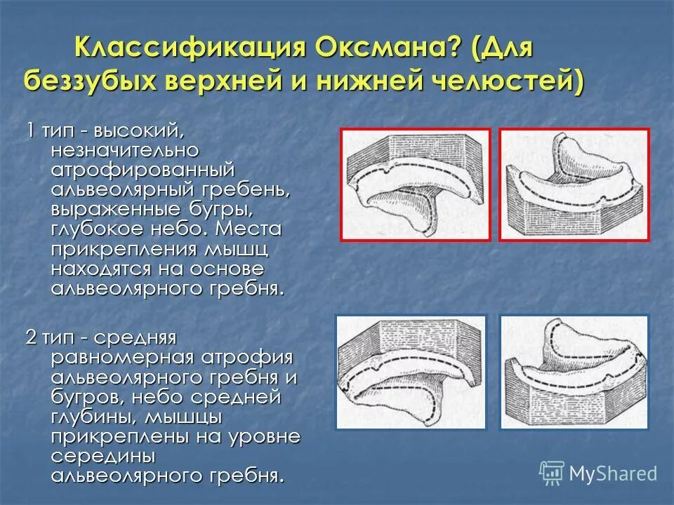 Классификация атрофии беззубых челюстей оксмана. Атрофия альвеолярного отростка по оксману. Классификация беззубых челюстей по оксману. Тип атрофии альвеолярного отростка по оксману. Классификация беззубых челюстей (шредера, келлера, оксмана.
