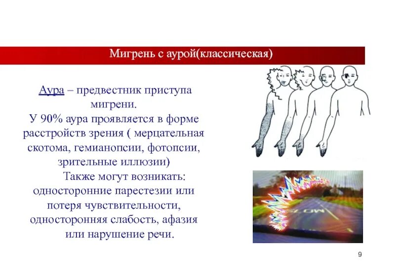 Предвестники мигрени с аурой. Мешрень Саурой. Классическая мигрень с аурой. Мигренозная Аура. Аура при мигрени что это