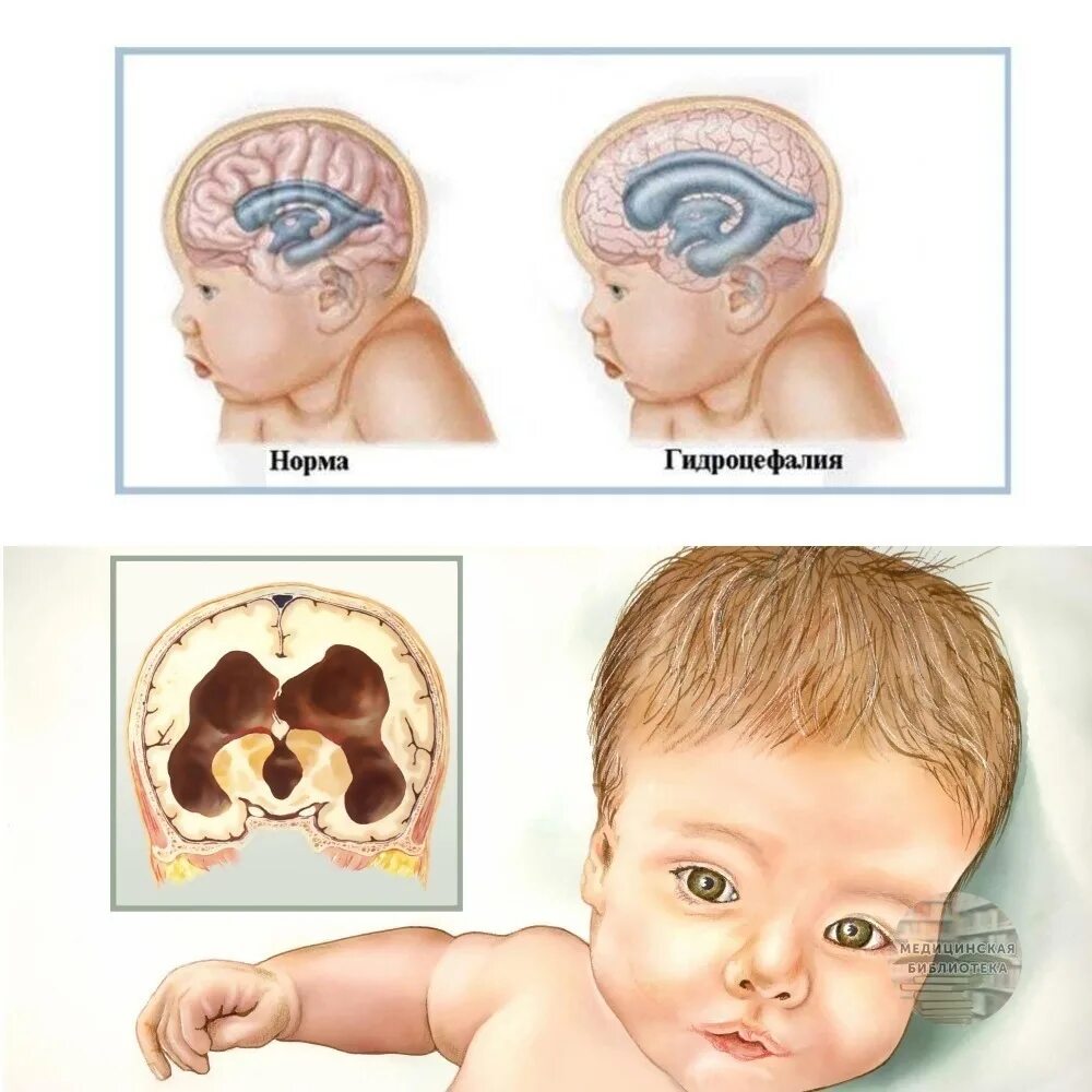 Причины гидроцефалии мозга. Гидроцефалия у новорожденных. Гидроцефалия головного мозга у ребенка. Гидроцефалия клинические проявления.