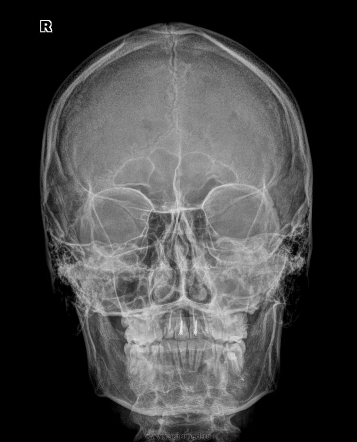 Кости черепа рентген. Рентген снимок скуловой кости. Рентгенограмма черепа в прямой проекции (по и.п.Королюк , 1996). Перелом скуловой кости рентген. Рентгеноанатомия костей черепа.