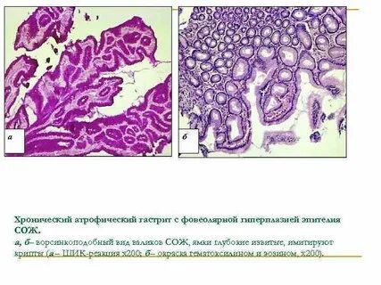 Фовеолярная гиперплазия желудка