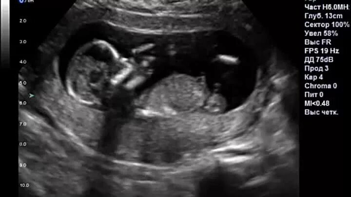14 недель мальчик. Снимок УЗИ 13 недель беременности мальчик. УЗИ 13-14 недель беременности девочка. УЗИ 12 недель беременности мальчик. Снимок УЗИ на 14 неделе беременности мальчика.