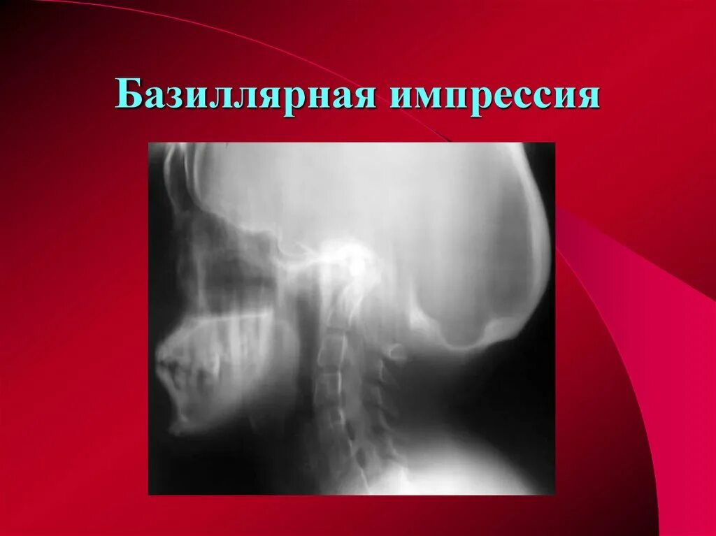 Импрессионный перелом мыщелка бедренной кости мрт. Импрессионный перелом мыщелка большеберцовой кости. Перелом шейки бедренной кости рентген. Импрессия кости. Импрессия кости.