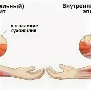 Эпикондилит клинические рекомендации. Локоть теннисиста латеральный эпикондилит. латеральный или медиальный эпикондилит. наружный эпикондилит локтевого сустава. эпикондилит локтевого сустава лечебная физкультура.