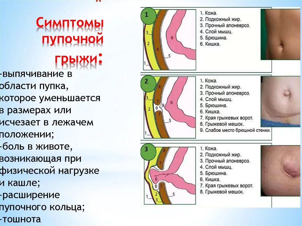 Как выглядит грыжа у человека Удалить пупочную грыжу в Подольске по доступной цене