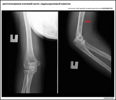 Чрезмыщелковый плечевой кости