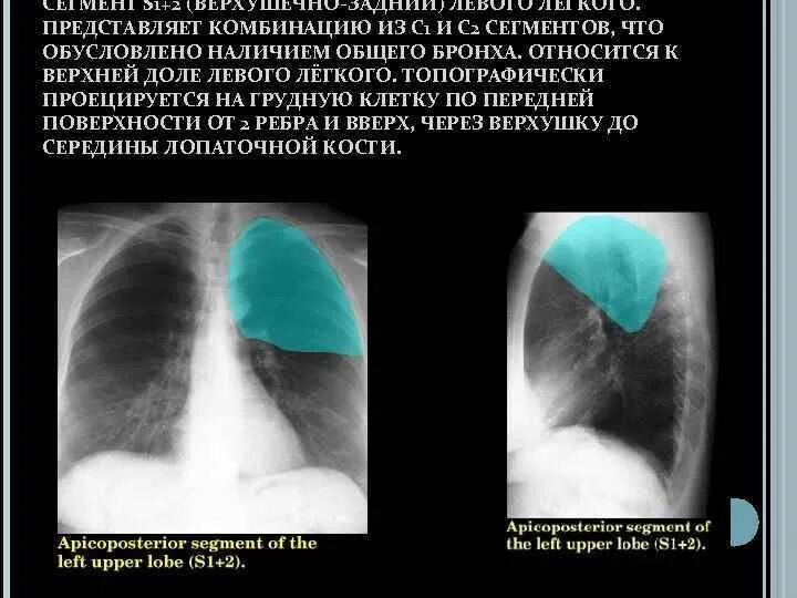 Пневмония верхней доли правого легкого схема. Пневмония верхней доли правого легкого. Образование левой доли легкого