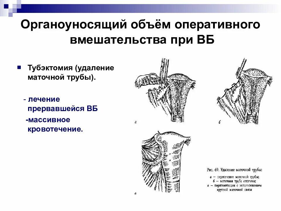 Объем оперативного лечения. Тубэктомия лапаротомия ход операции. Тубэктомия схема операции. Тубэктомия этапы операции. Удаление маточной трубы этапы.