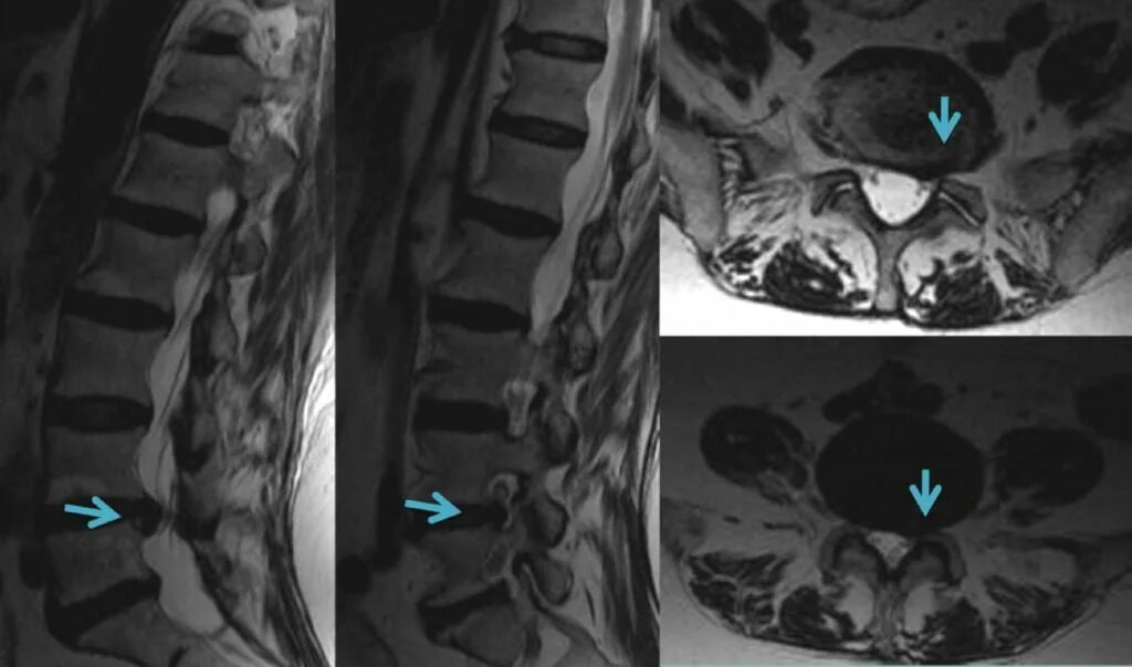 Грыжа на мрт поясничного отдела мрт. Межпозвоночная грыжа поясничного отдела мрт. Грыжа позвоночника поясничного отдела на снимке мрт.
