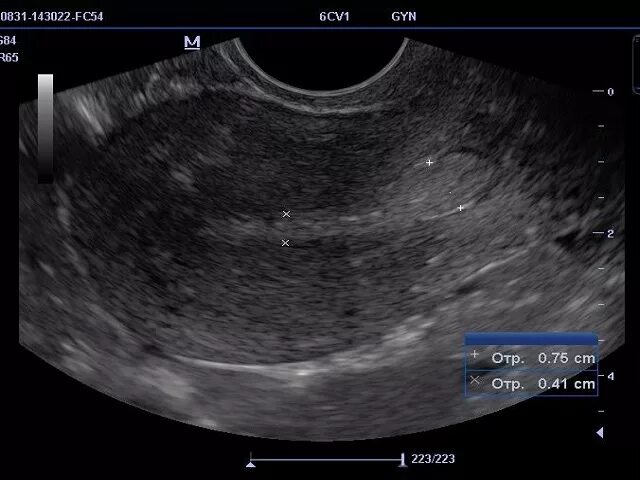 Отслойка эндометрии. Железисто-фиброзный эндометриальный полип. Пóлип в полости матки аденоматозный.