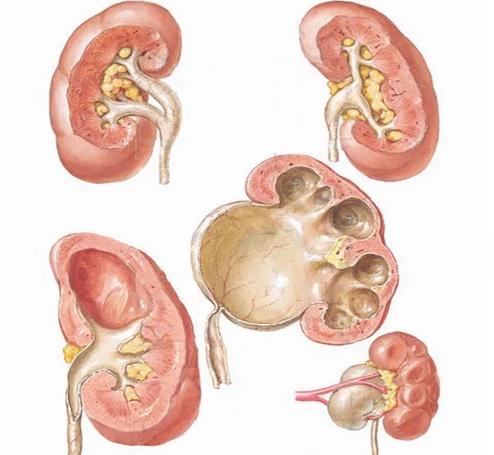 Почки лоханка причины. Расширение лоханки гидронефроз. Гидрокаликоз почек. Расширение лоханки почки пиелоэктазия.