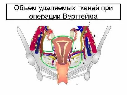 Гистерэктомия трубами