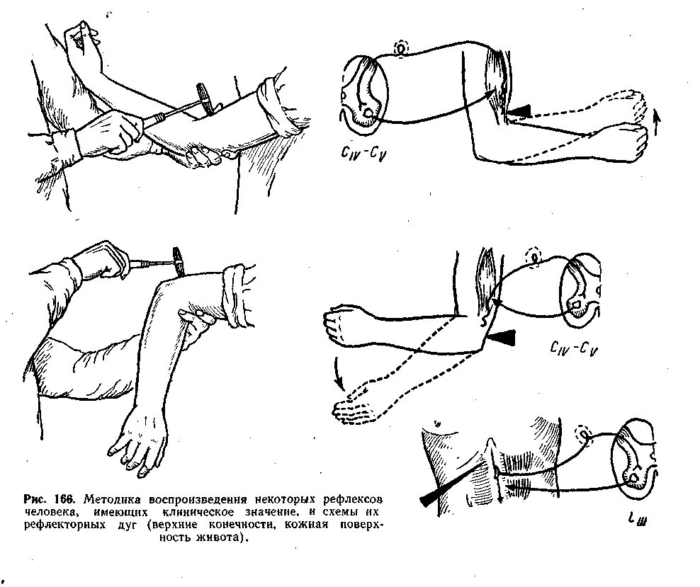 Сухожильные рефлексы верхней конечности. Сухожилия рефлекса верхней конечности. Исследование сухожильных рефлексов верхних конечностей неврология. 2. Исследовать сухожильные рефлексы верхних конечностей..