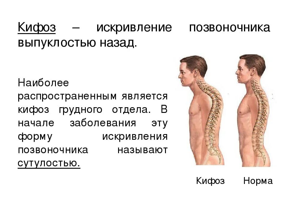 Изгиб позвоночника в сторону называется. Деформация позвоночника кифоз. Кифоз грудного отдела позвоночника кифоз. Искривление позвоночника лордоз кифоз сколиоз. Сколиоз кифоз грудного отдела.