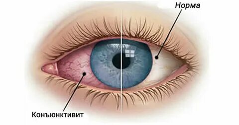 Конъюнктивит взрослый сколько дней