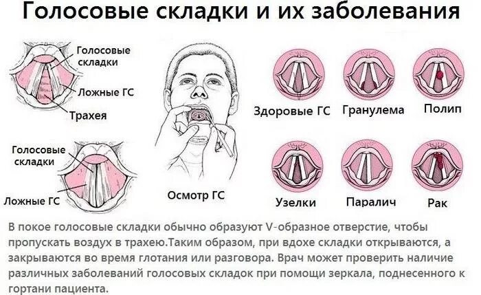 Узлы гортани